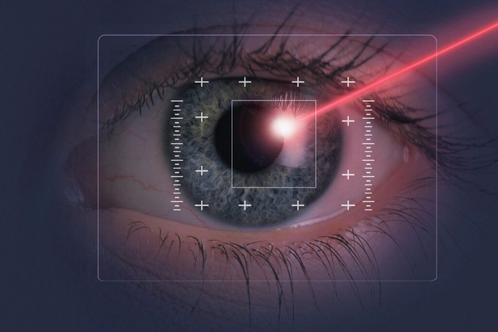 Eye undergoing laser vision correction surgery.