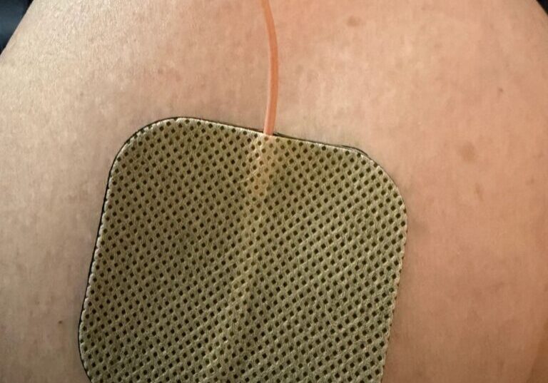 Electrode pad attached to a person's skin.